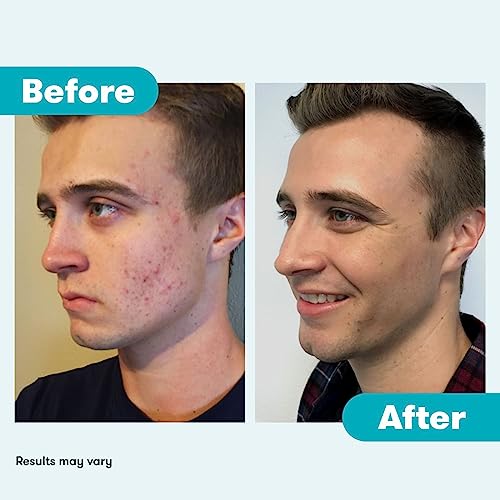 Proactiv 3 Step Acne Treatment - Benzoyl Peroxide Face Wash, Repairing Acne Spot Proactiv uk supplements