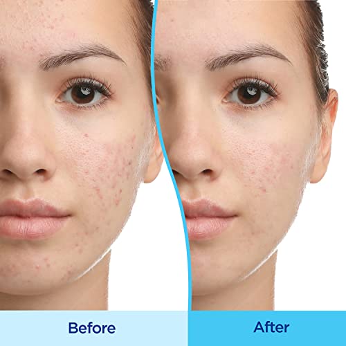 Differin Acne Treatment Gel, 30 Day Supply, Retinoid Treatment for Face Differin uk supplements