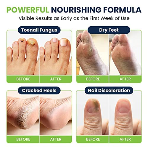 Toenail Fungus Treatment Extra Strength - Advance nail fungus treatment for fingernails FOOT CURE uk supplements
