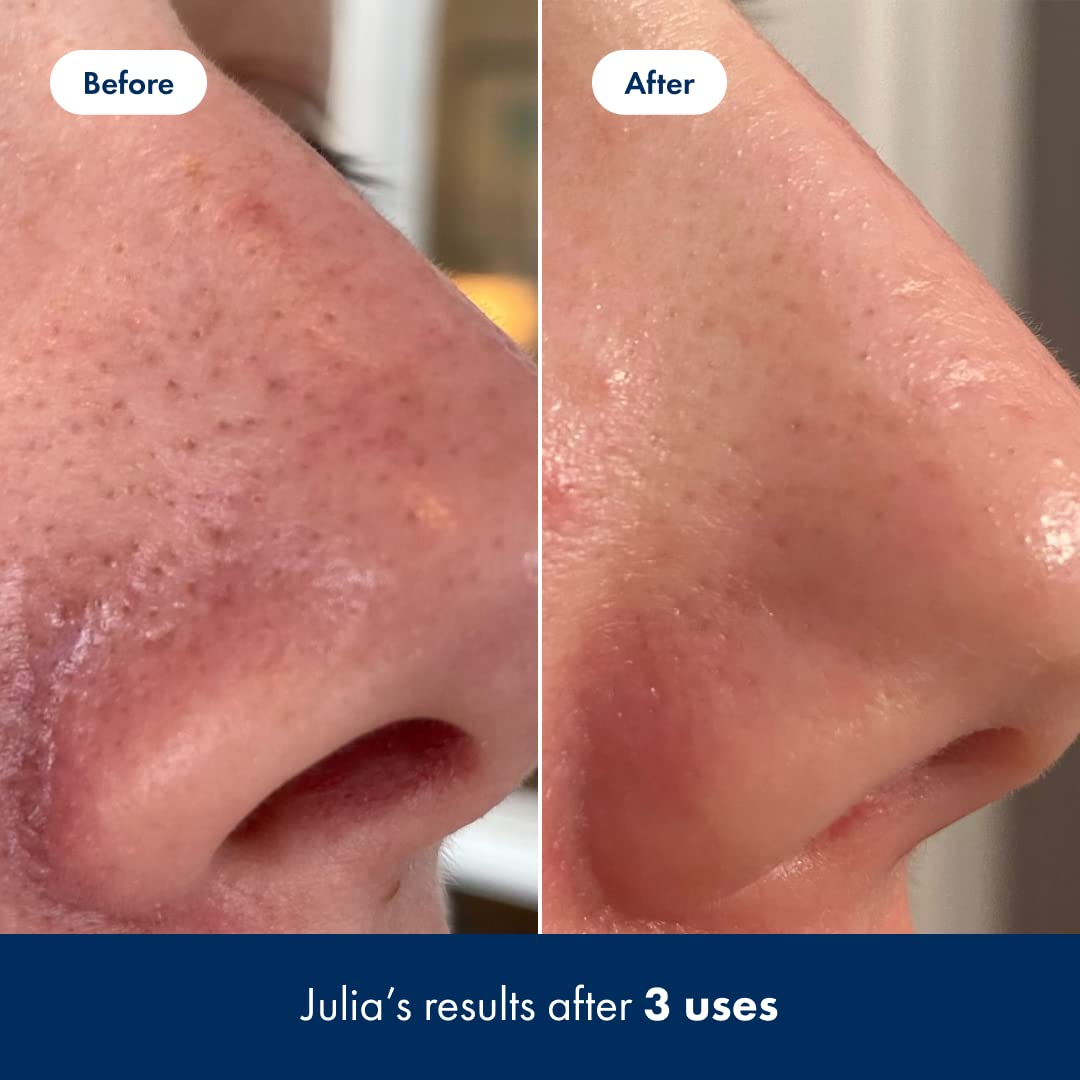 Hero Cosmetics Pore Release Blackhead Clearing Solution - Exfoliating Toner Featuring BHA HERO COSMETICS uk supplements