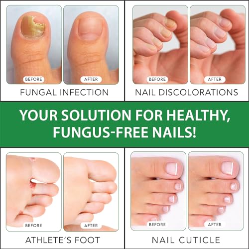 Viking Revolution Toenail Fungus Treatment Extra Strength with 1% Tolnaftate OTC Viking Revolution uk supplements