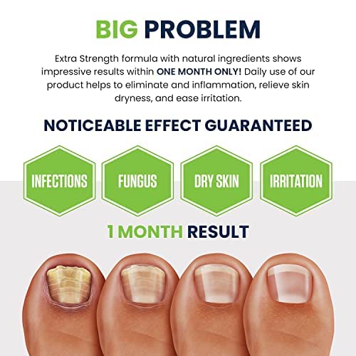 Toenail Fungus Treatment Extra Strength - Advance nail fungus treatment for fingernails FOOT CURE uk supplements