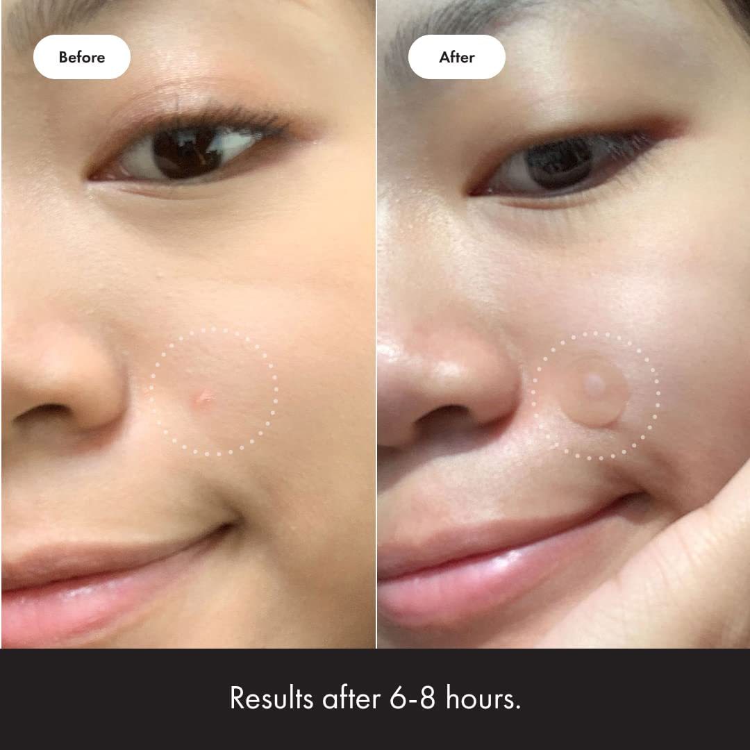 Mighty Patch Original from Hero Cosmetics - Hydrocolloid Acne Pimple Mighty Patch uk supplements