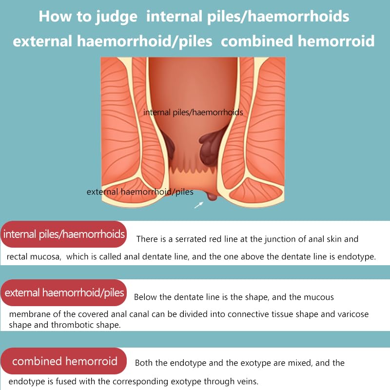 Hemorrhoid Cream for Men and Women, with Lidocaine and Phenylephrine HCl, Provides Fast Relief from hemorrhoid discomfort. Naturally formulated for Hemorrhoids and fissures (0.7 oz) Anisx uk supplements