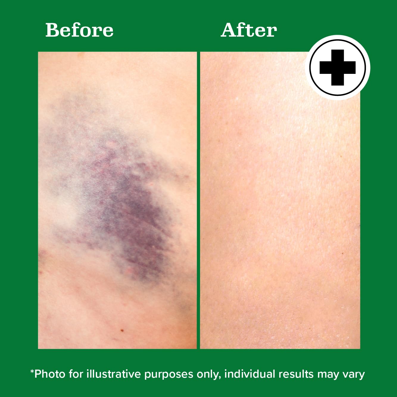 Miracle Plus Arnica Bruise Relief Gel + Magnesium Leg Relief Cream Bundle Miracle Plus uk supplements