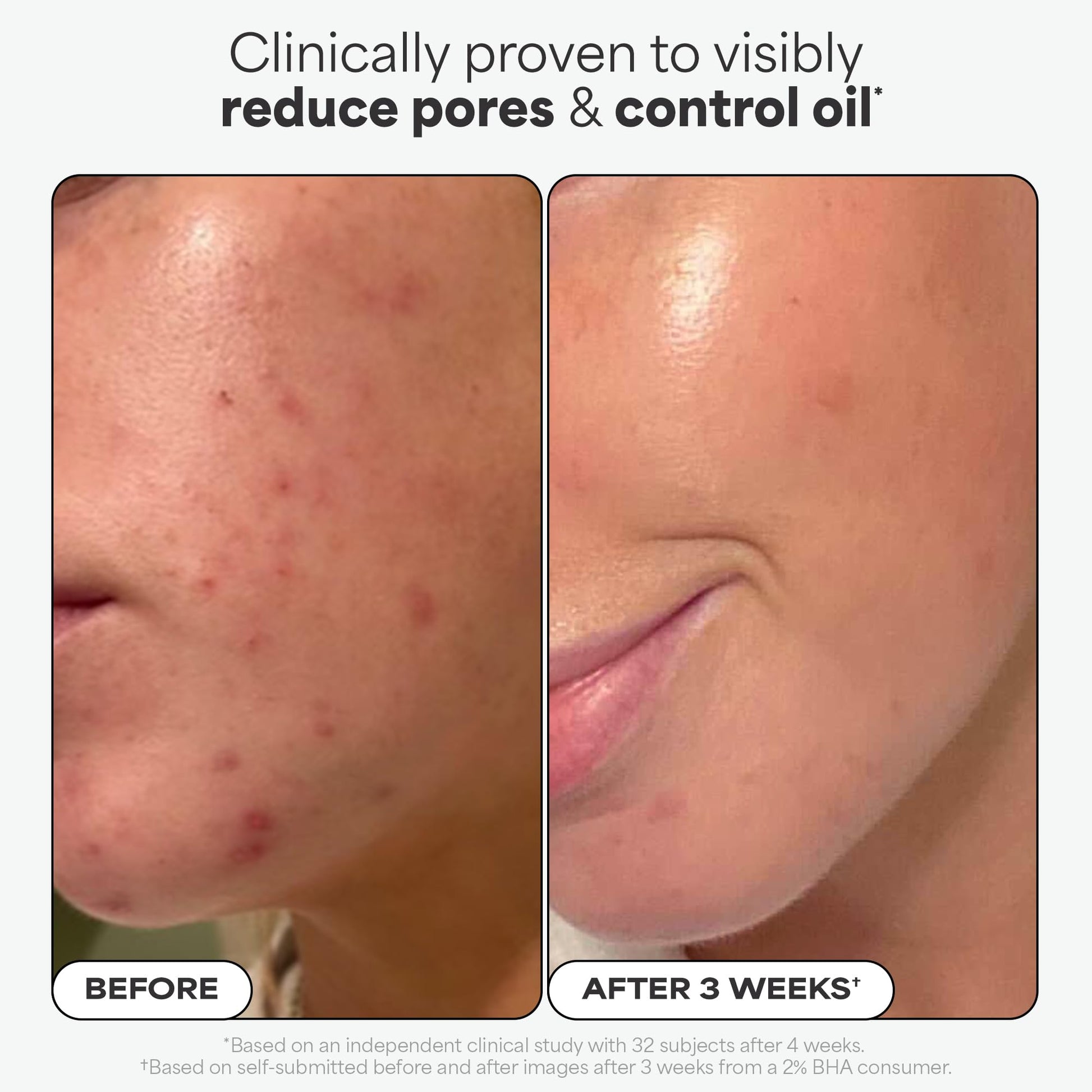 Paulas Choice--SKIN PERFECTING 2% BHA Liquid Salicylic Acid Exfoliant--Facial Exfoliant for Blackheads, Enlarged Pores, Wrinkles & Fine Lines, 4 oz Bottle Paula's Choice uk supplements