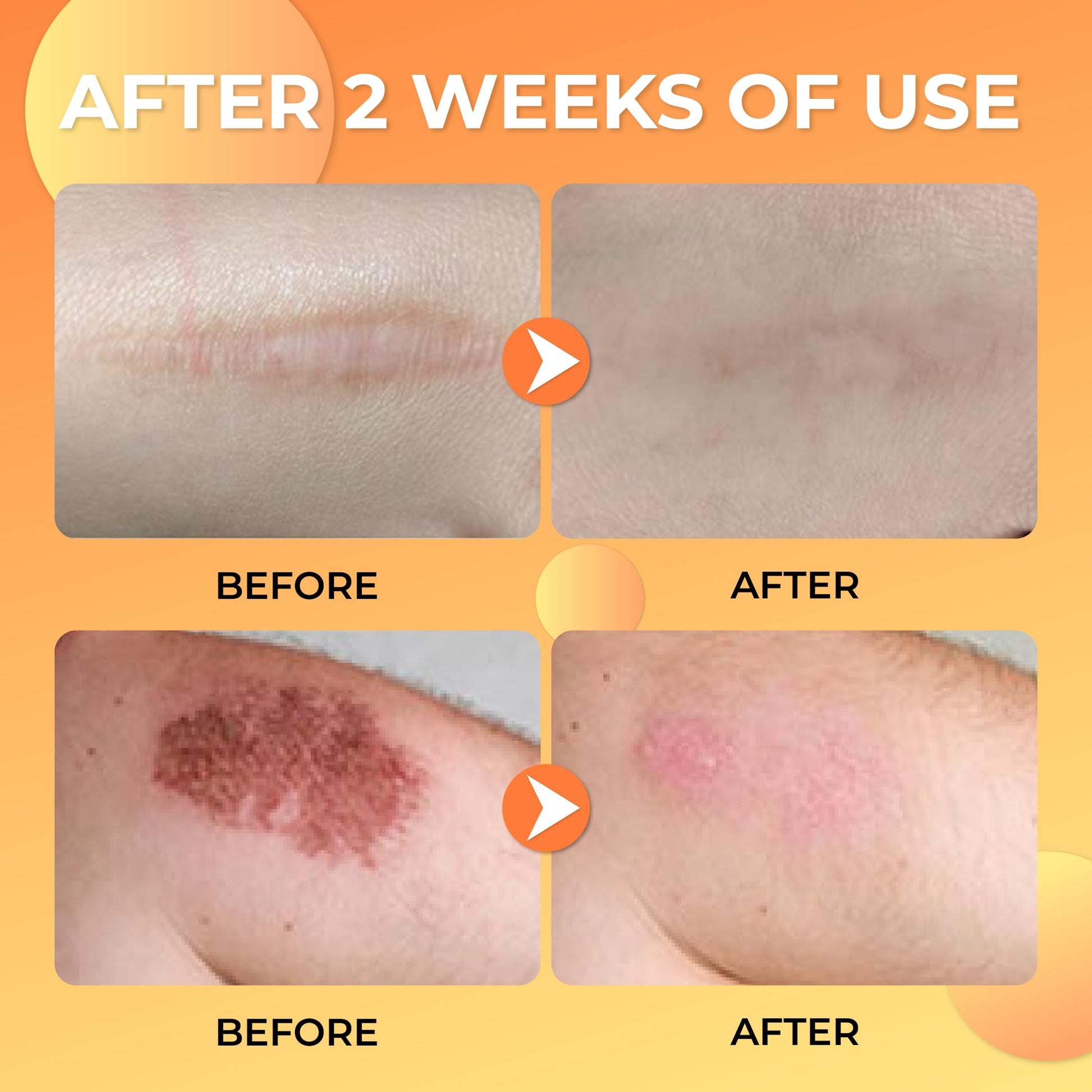 ABERA Scar Removal Cream for Women and Men - Rapid Repair of New Old Scars, Spots, Burns All Natural Treatment with Vitamin E, Alanine, Collagen (1 Box + 3 Eye Patch) ABERA uk supplements