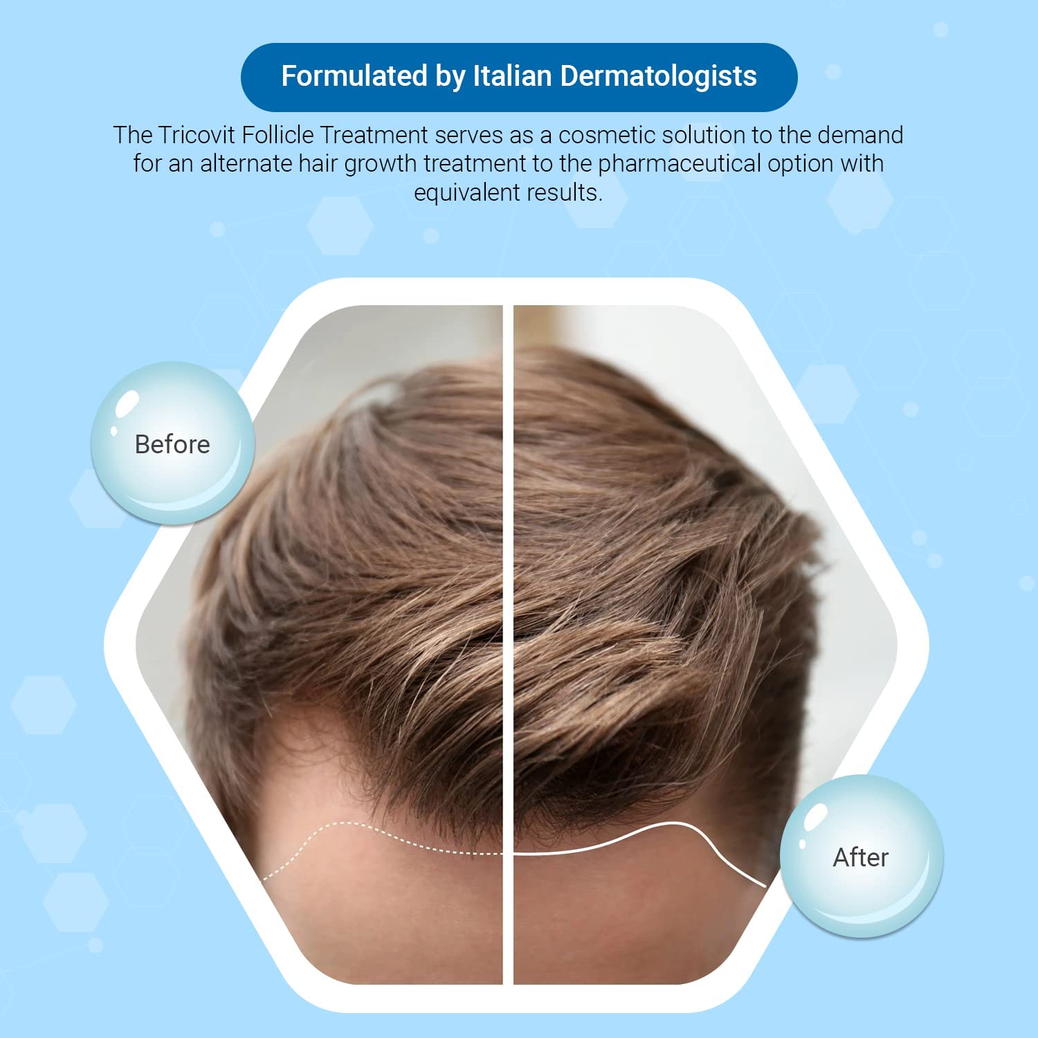 Tricovit Hair Growth Supplement - Nail & Hair Health Vitamins with Amino Acids, Minerals & Antioxidants - Dermatologist-Formulated & Gluten-Free Vitamins and Supplements for Women & Men (60 tablets) Tricovit uk supplements