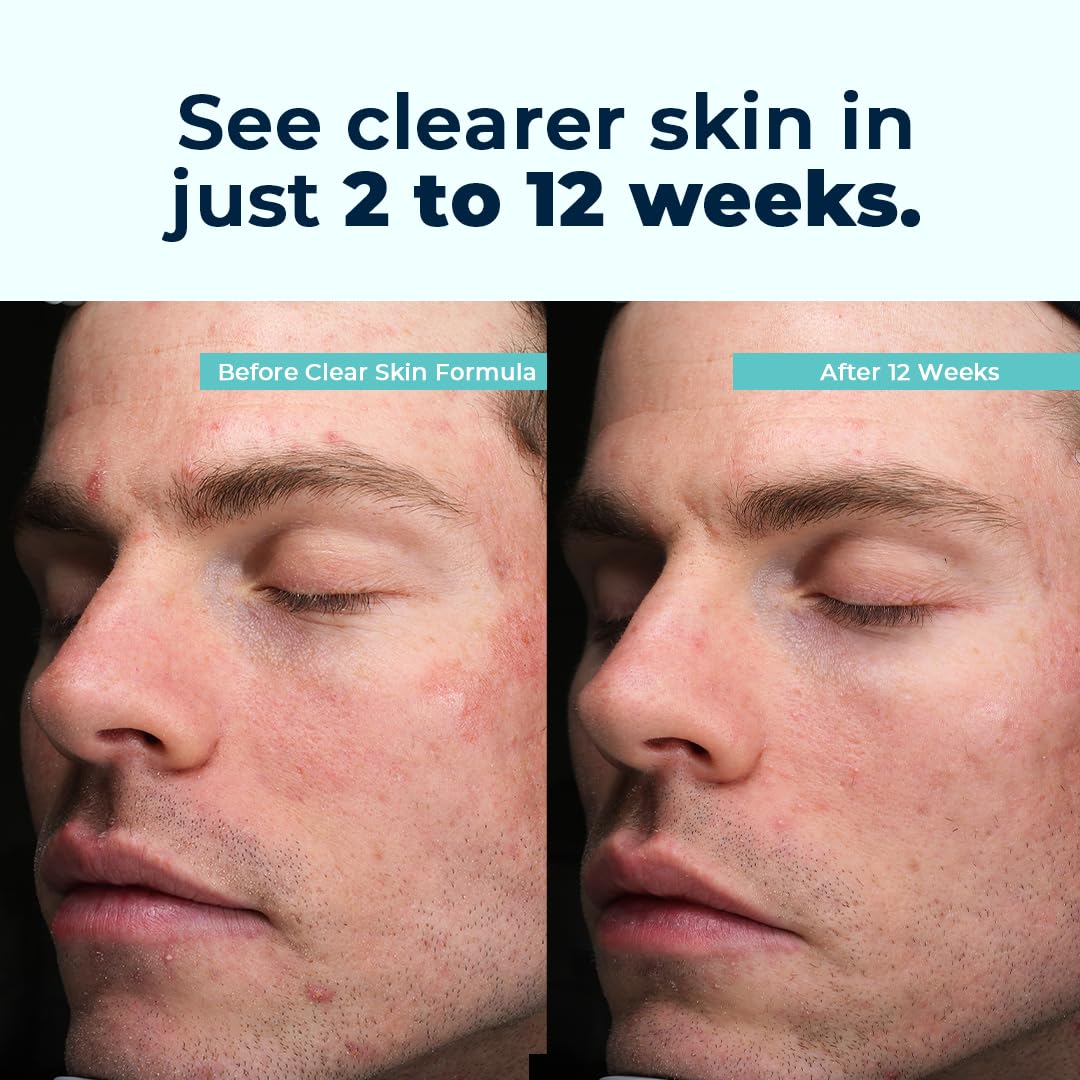 VitaMedica Clear Skin Vitamin Formula | Noncystic Acne Supplement for Skin Clearing | Breakout Treatment for Women and Men | Vitamins A, C, E, Selenium, Chromium, and Zinc for Skin Health | 2 Pack VitaMedica uk supplements