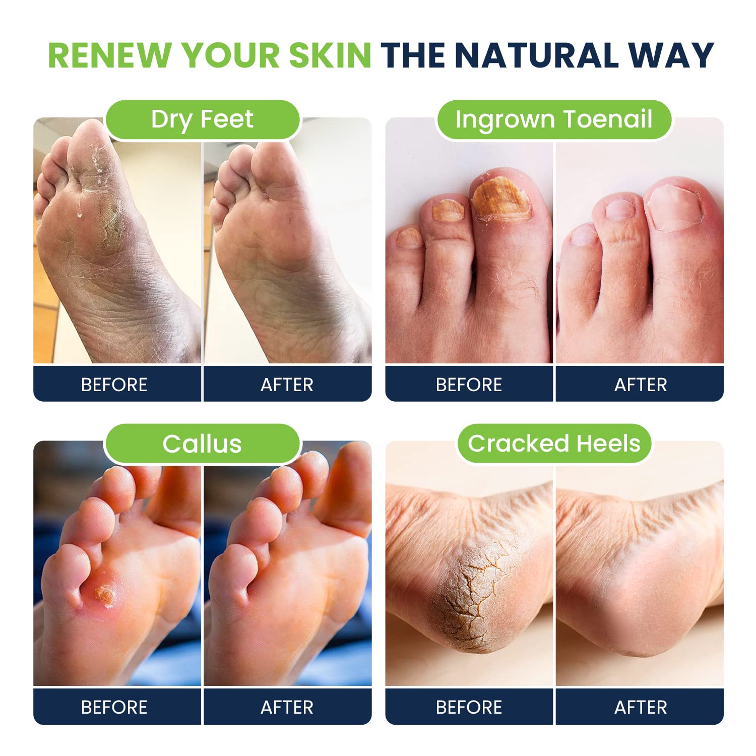 Foot Soak with Epsom Salts- Variety Pack of 4- Tea Tree Oil, Muscle Relief, Calming FOOT CURE uk supplements