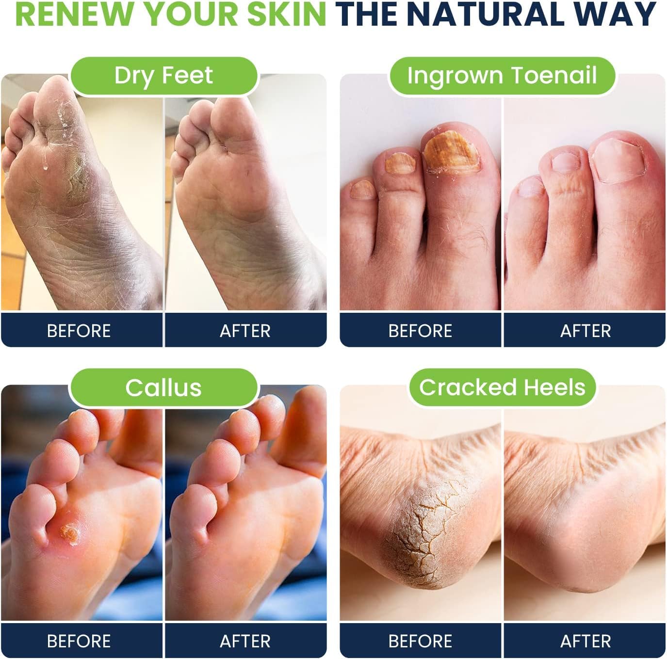 Tea Tree Oil & Citrus Detox Foot Soak with Epsom Salts - All Natural Salts for Post Workout FOOT CURE uk supplements