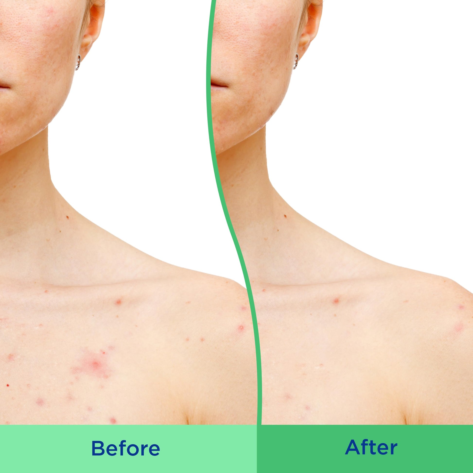 Differin Body Scrub with Salicylic Acid Acne Clearing Improves Tone and Texture Prone Skin Differin uk supplements