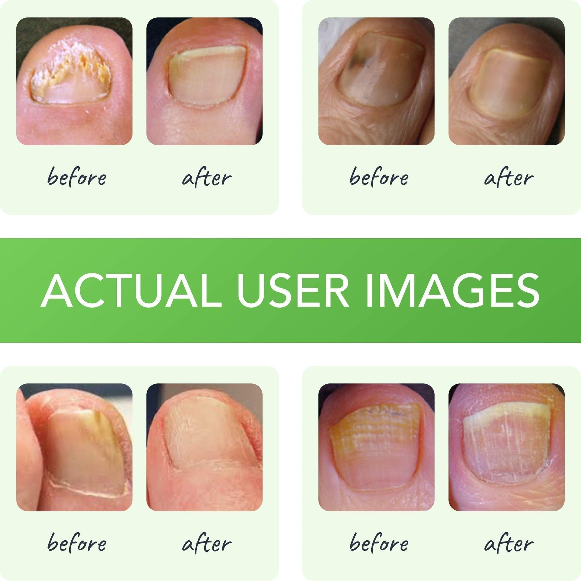 FUNGINIX Healthy Nail Formula - Finger And Toe Fungus Treatment, Made In USA, Foot FUNGINIX uk supplements