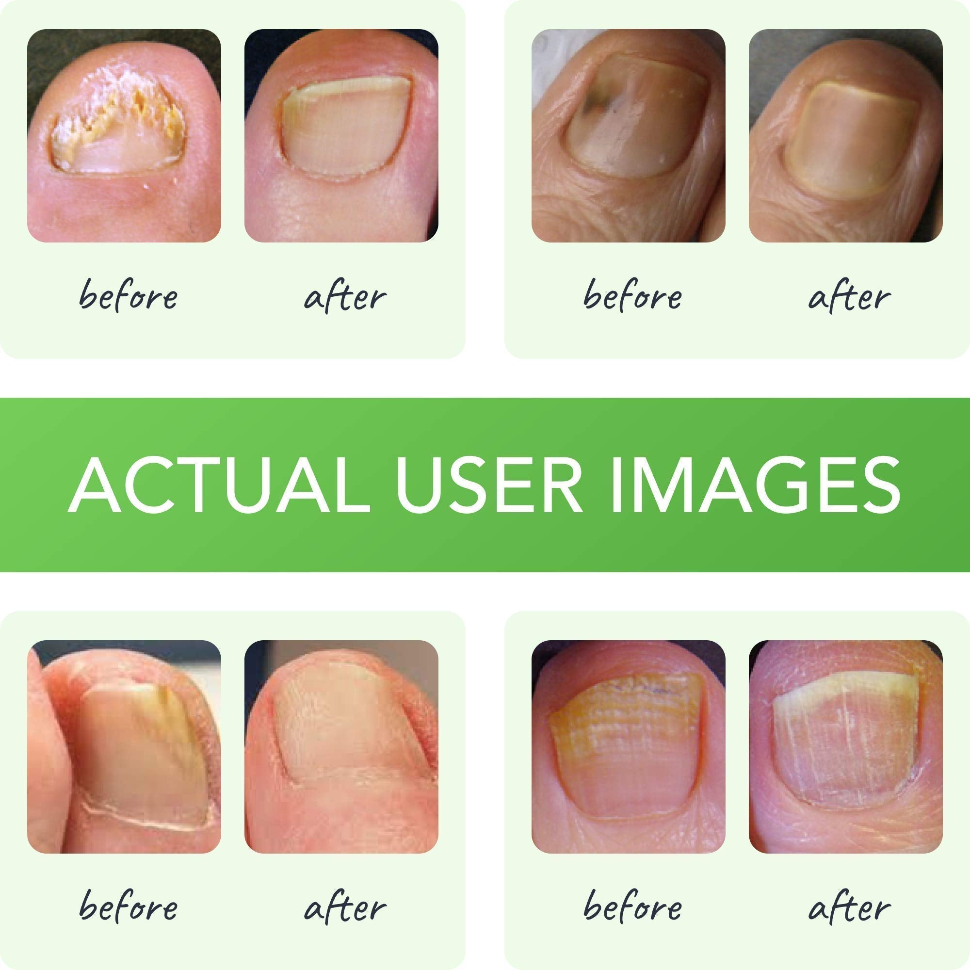 FUNGINIX Healthy Nail Formula - Finger And Toe Fungus Treatment, Made In USA, Foot FUNGINIX uk supplements