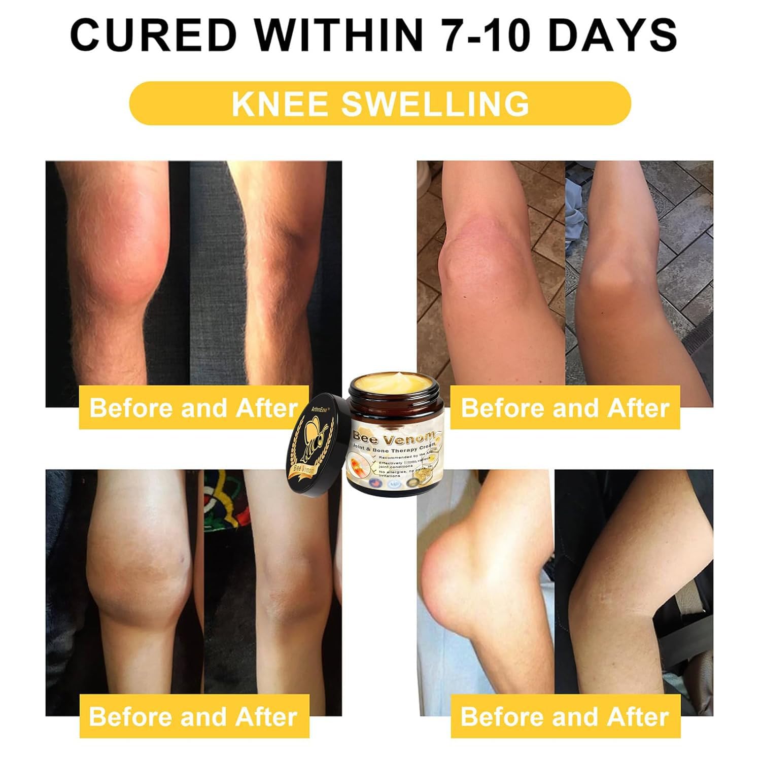 ArthroEase Bee Venom Arthritis Cream, Joint & Muscle Soothing Bee Venom Cream, Professional Bee Venom Joint Cream, Bee Venom Joint Gel - Specially for for Back, Neck, Hands, Knee (2 Bottle) Lmoy uk supplements