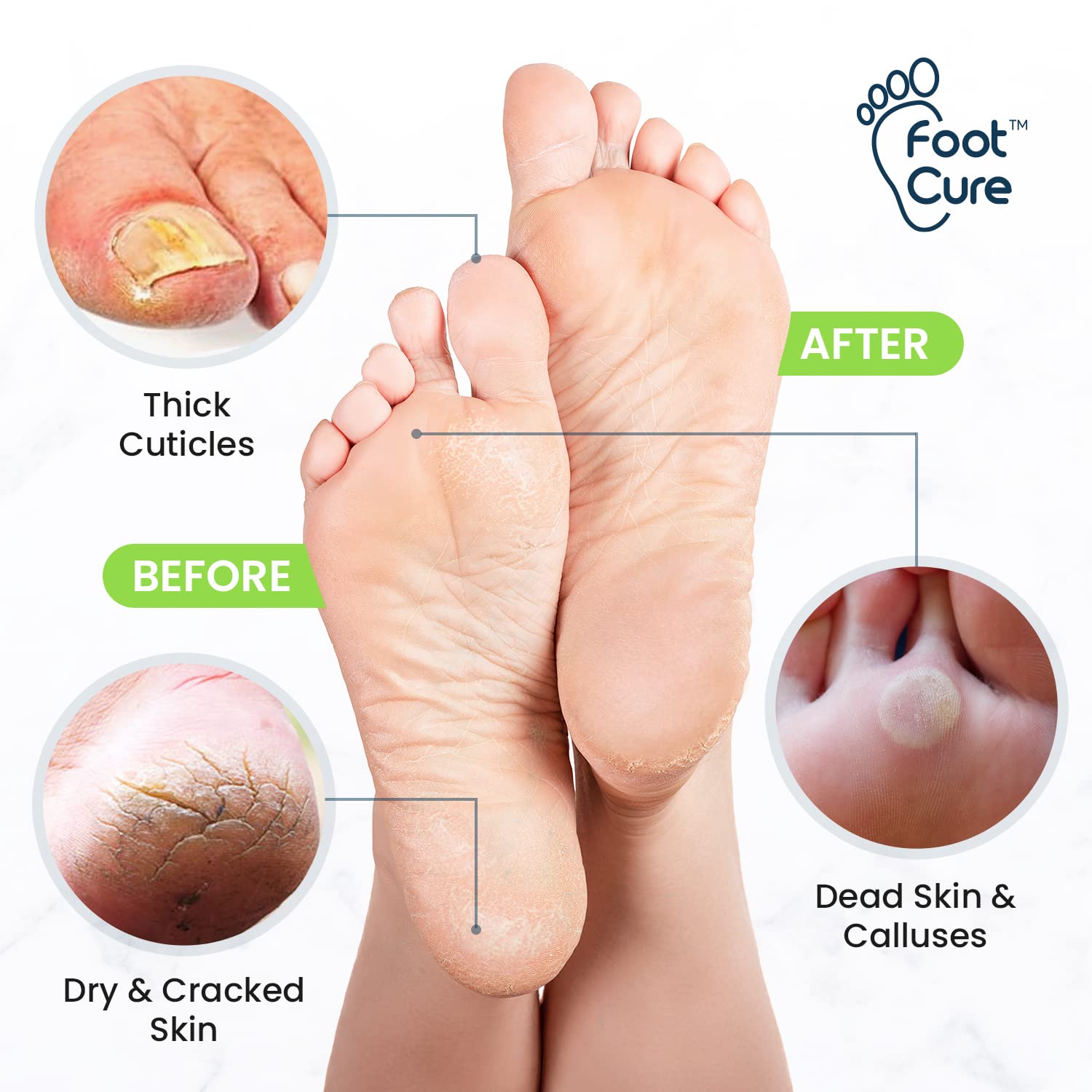 Toenail Fungus Treatment Extra Strength - Advance nail fungus treatment for fingernails FOOT CURE uk supplements