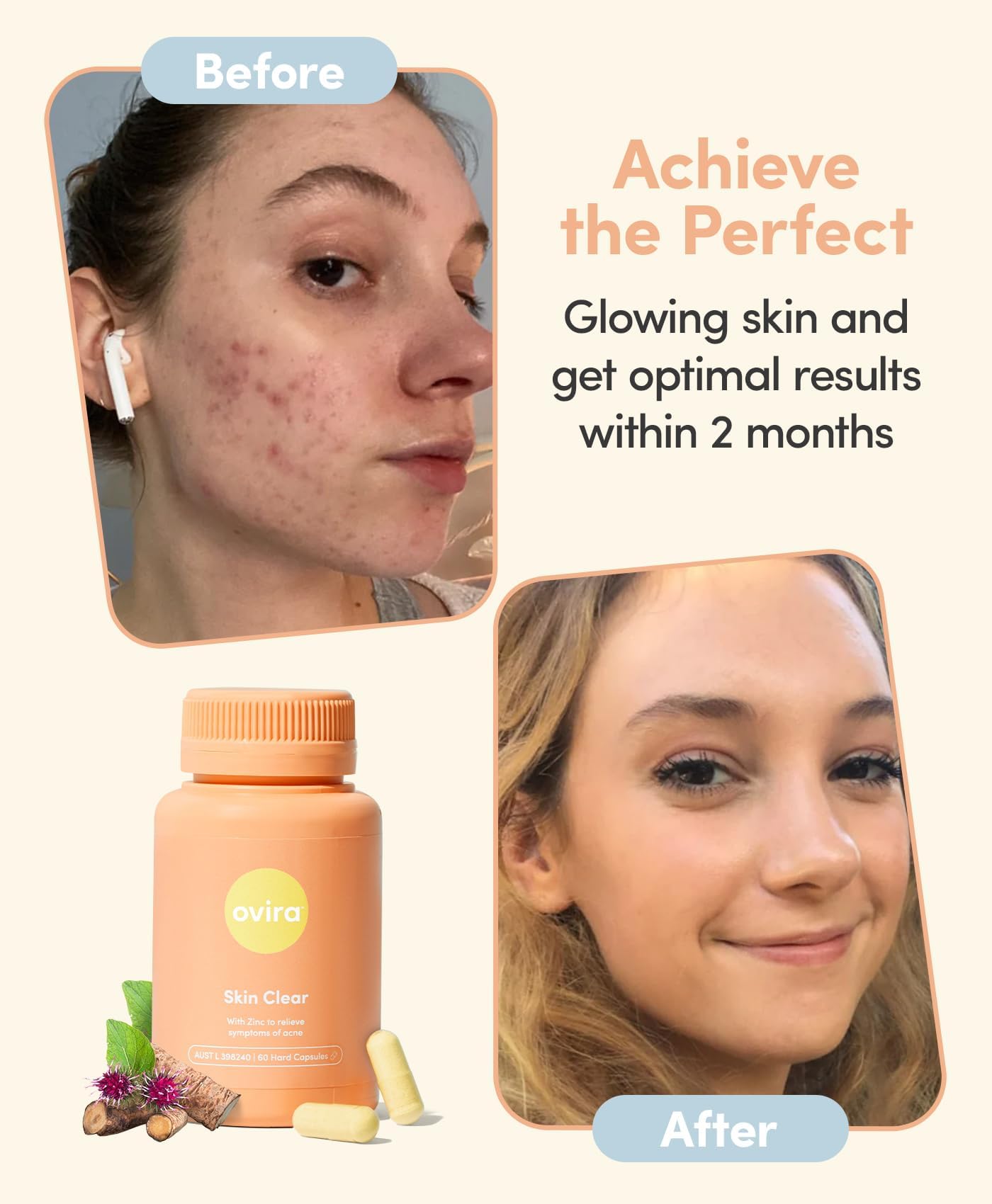 Ovira Skin Clear with ZINCBRIGHT - 60 Capsules for Clear and Glowing Skin | Rosacea & Hormonal Acne Treatment | Support Collagen Production | Acne Supplements for Women & Men - Pack of 2 Ovira uk supplements