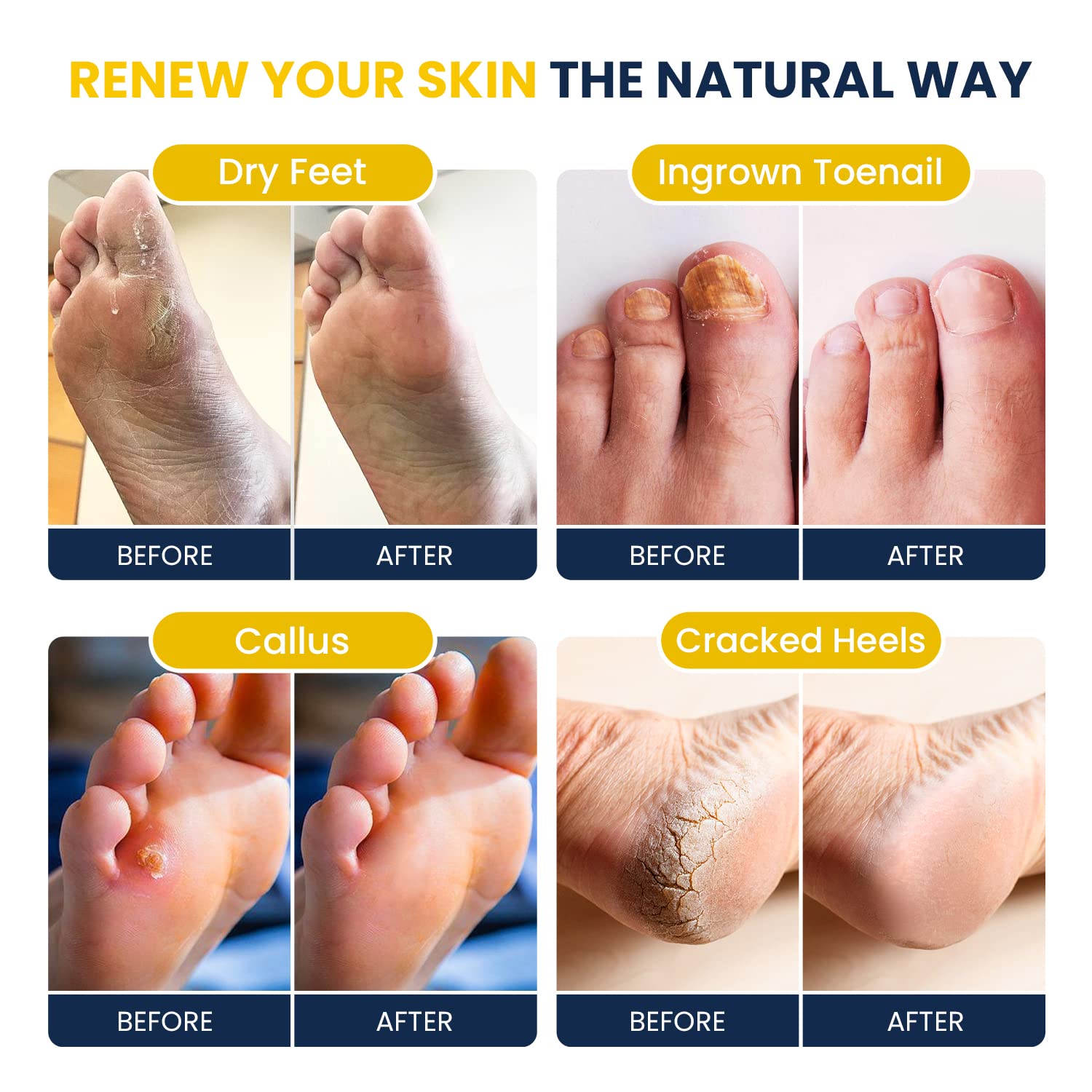 Citrus Detox Foot Soak With Epsom Salts - for Foot Callus, Immune Boost, Damaged Toenail FOOT CURE uk supplements