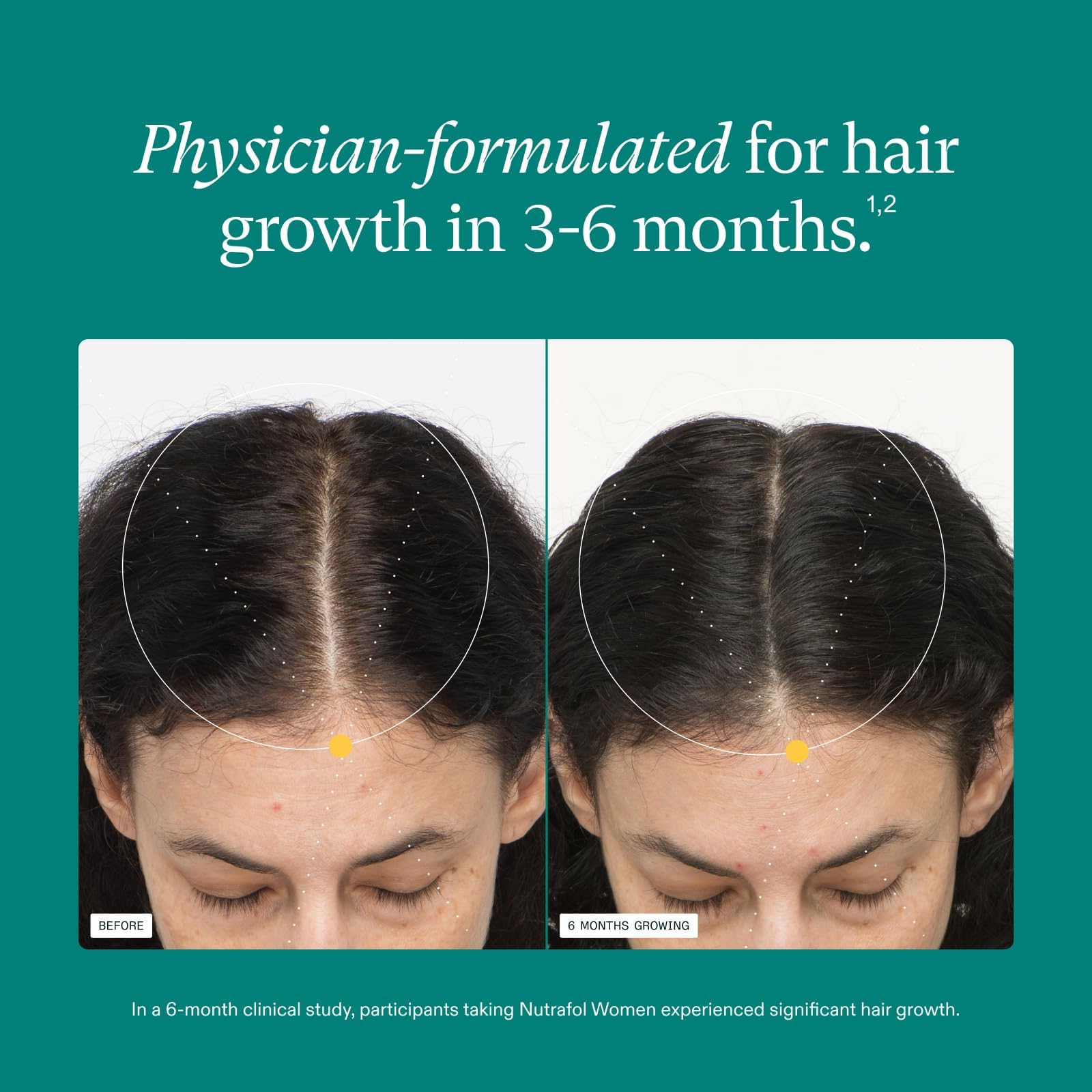 Nutrafol Women's Hair Growth Supplements, Ages 18-44, Clinically Proven for Visibly Thicker and Stronger Hair, Dermatologist Recommended - 1 Month Supply Nutrafol uk supplements