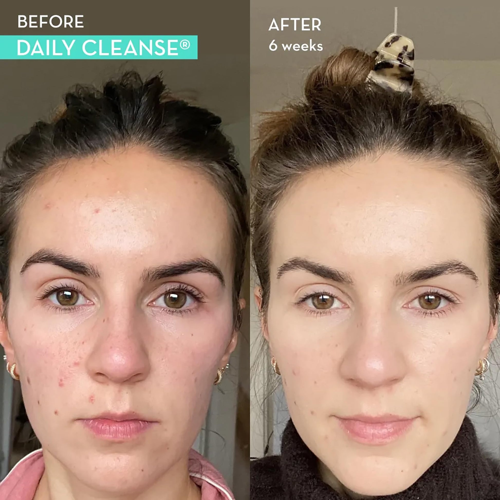 HUM Daily Cleanse Acne Supplements - Support for Clear Skin & Improved Digestion HUM uk supplements