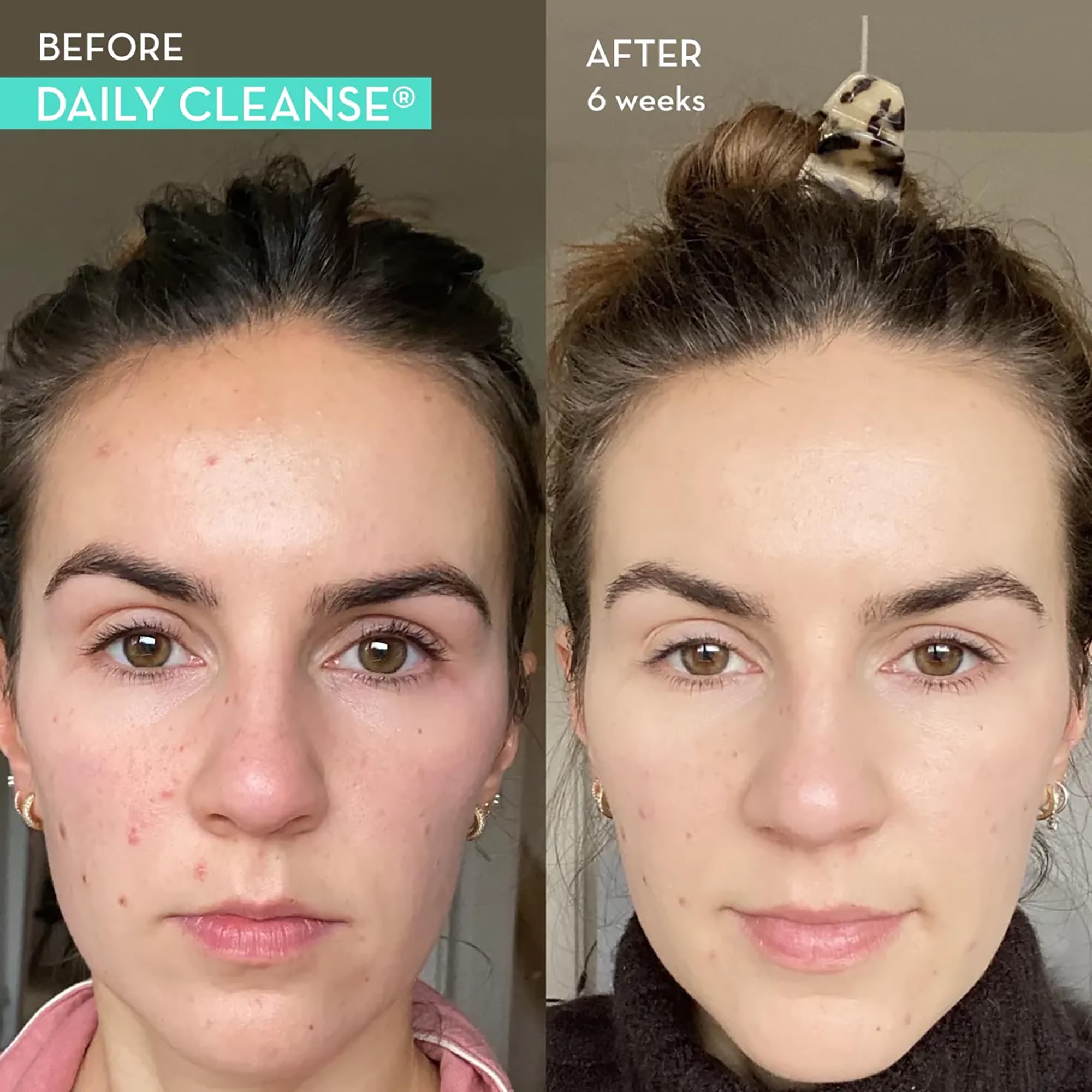 HUM Daily Cleanse Acne Supplements - Support for Clear Skin & Improved Digestion HUM uk supplements