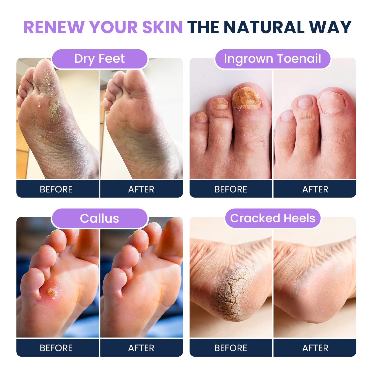Soothing Lavender Foot Soak with Epsom Salt - Best Toenail Treatment, & Softens Calluses FOOT CURE uk supplements