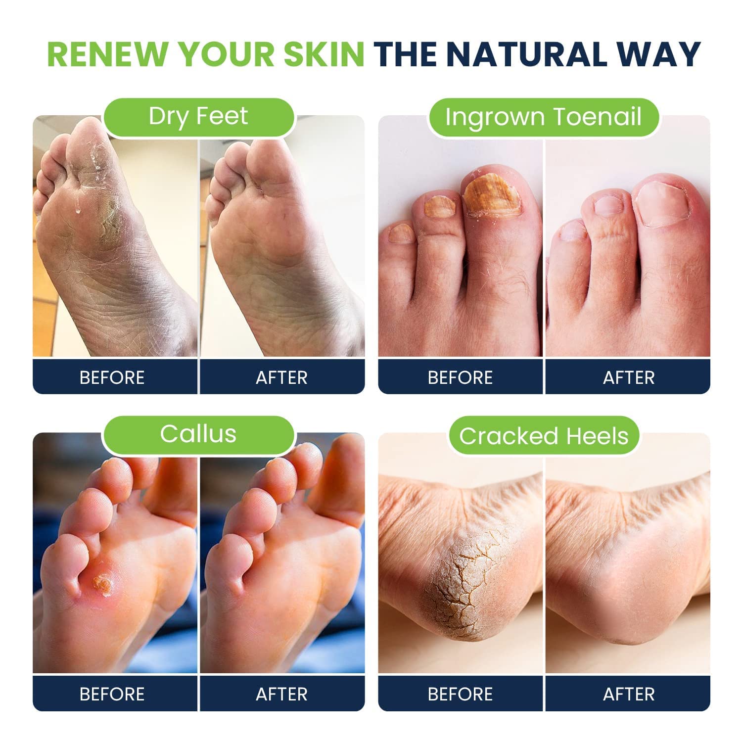 Tea Tree Oil Foot Soak with Epsom Salt - Best Toenail Fungus Treatment, Athletes FOOT CURE uk supplements