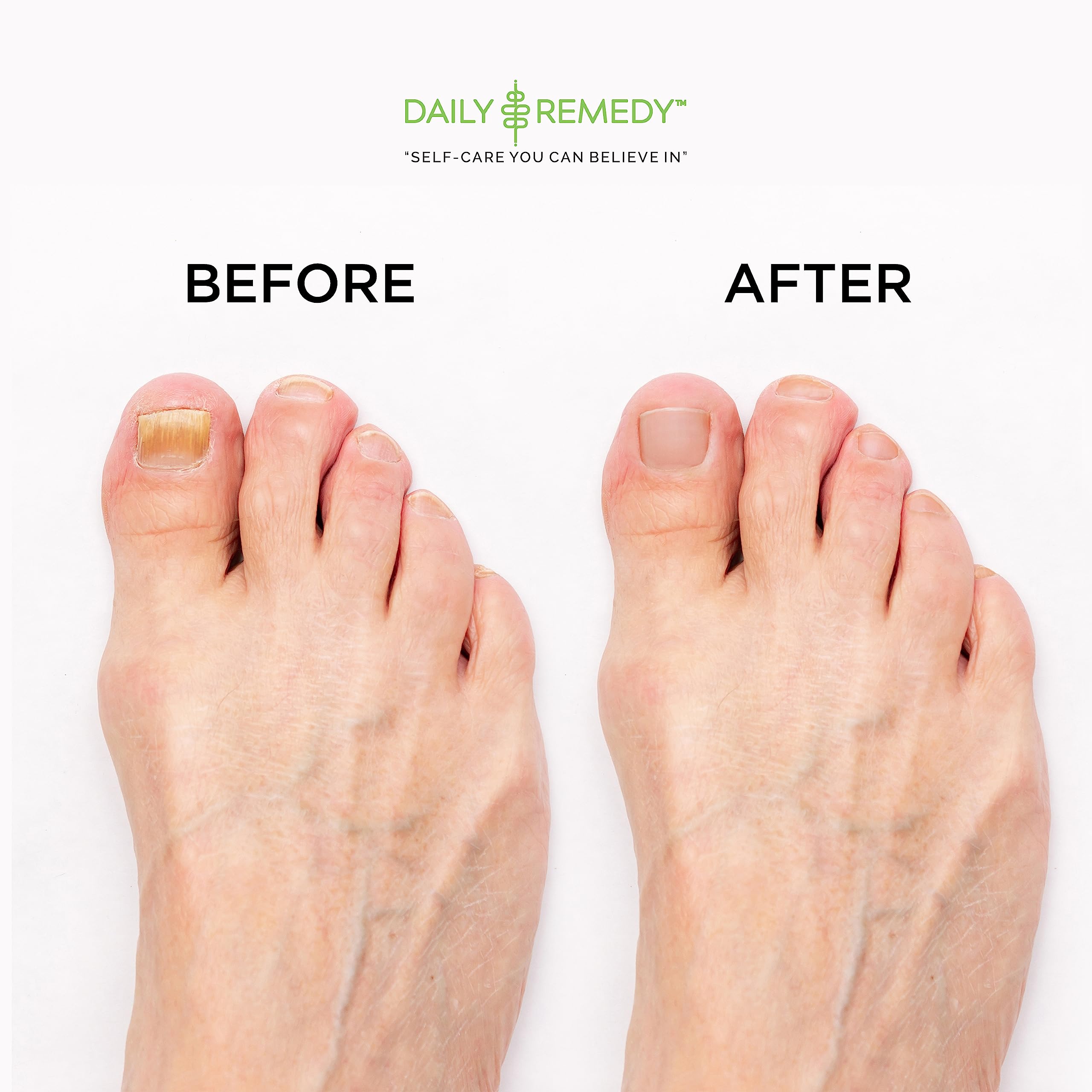 EXTRA STRENGTH Tea Tree Oil Foot Soak with Epsom Salt - Made in USA - for Toenails DAILY REMEDY uk supplements