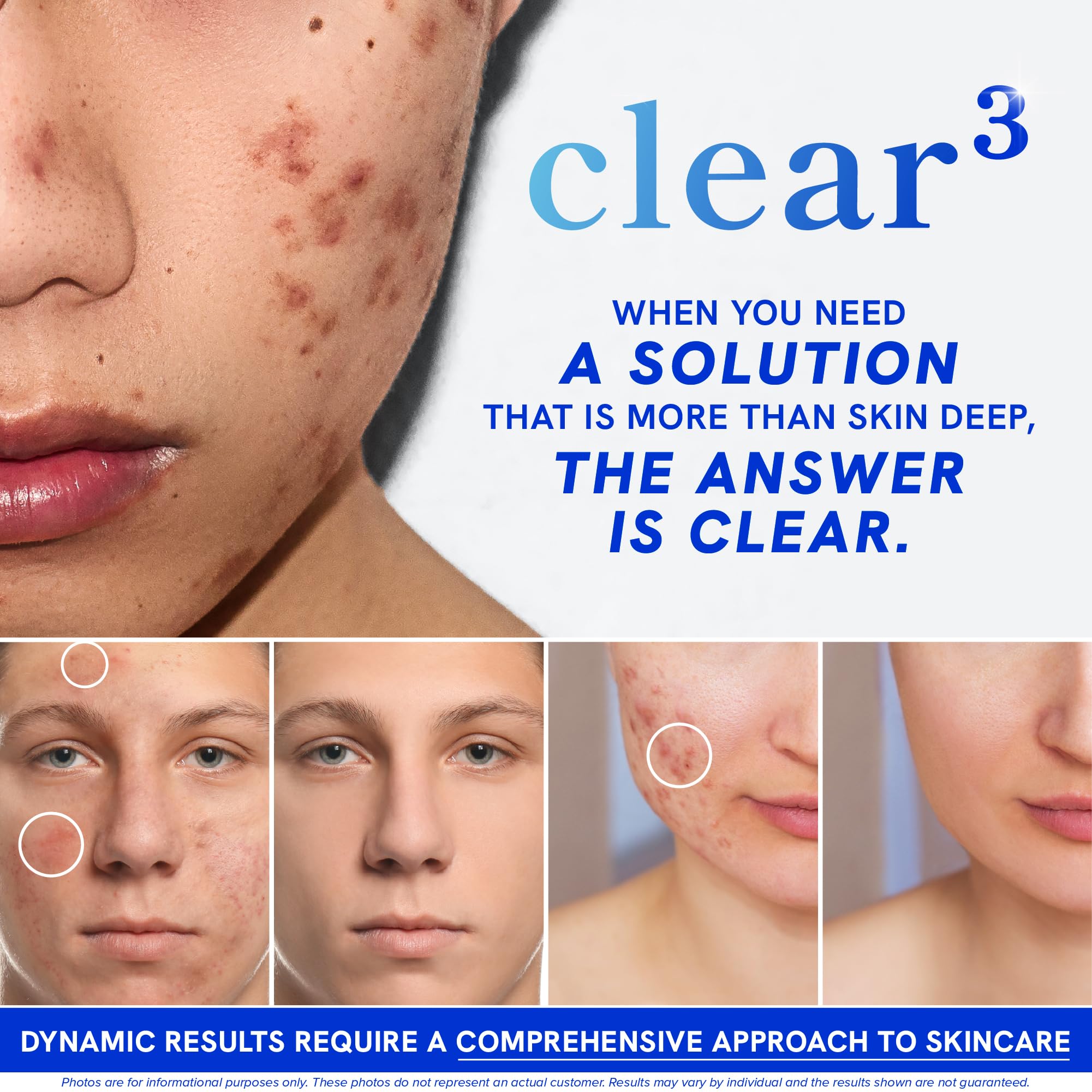 Clear Skin Supplement with Zinc, DIM & Probiotics | 3-in-1 Balance, Glow & Health Skin Support | Triple Action Hyaluronic Acid, Niaciminide & Vitamins for Hormone, Complexion & Gut Support | 180 Ct SMNutrition uk supplements