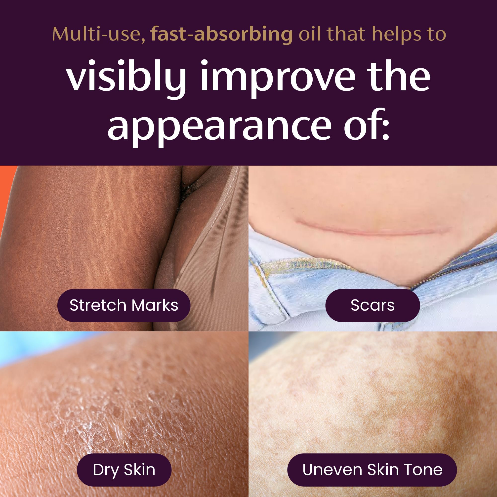 Mederma Quick Dry Oil, Scar and Stretch Mark Treatment, Helps to Improve the Appearance with Natural Botanical Extracts, Paraben Free, Fast-Absorbing, 3.4oz (100ml) Mederma uk supplements