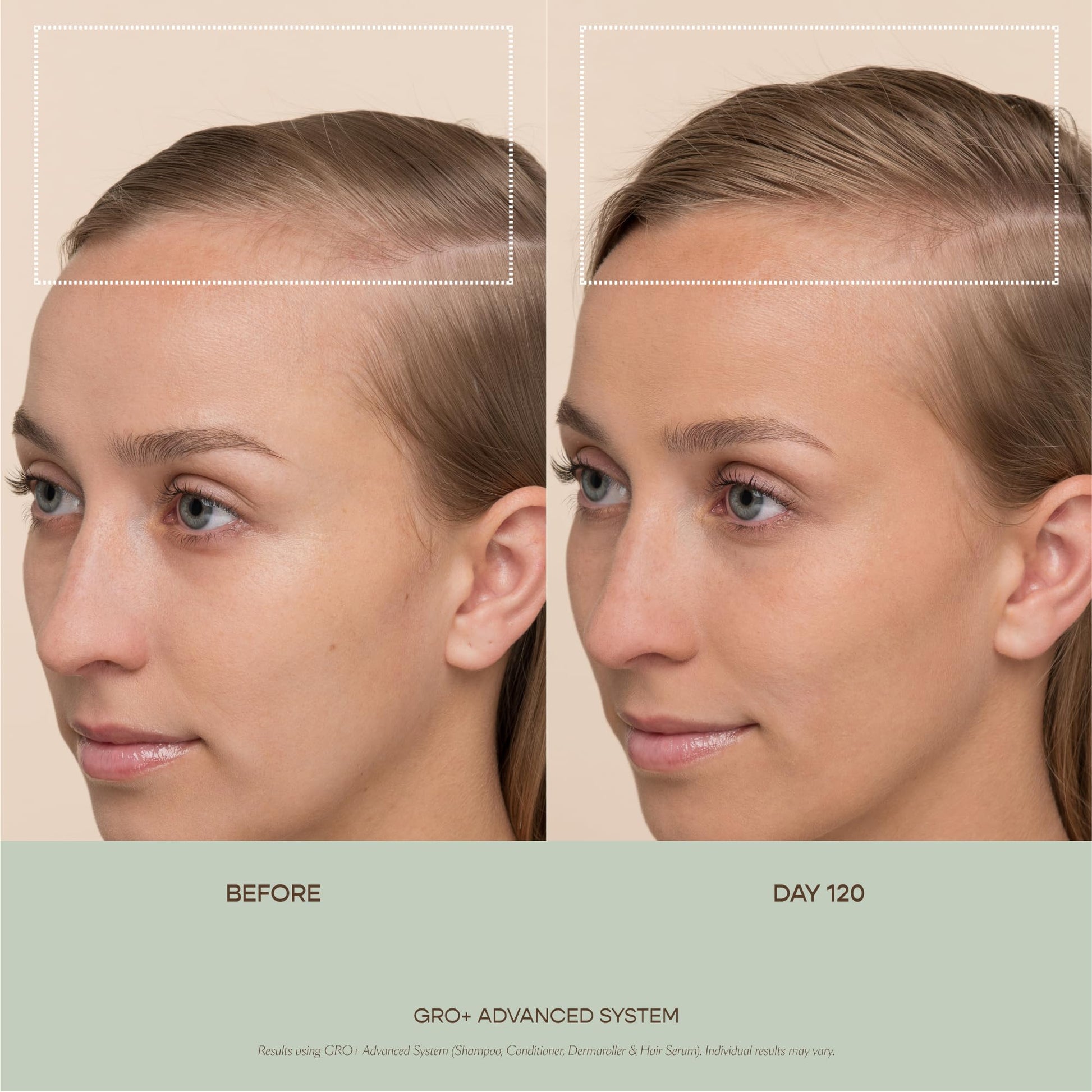 VEGAMOUR GRO+ Advanced Dermaroller | 1,200 Microneedle 0.25mm Scalp Tool | Gently Exfoliates the Scalp | Wide Head for Maximum Coverage VEGAMOUR uk supplements