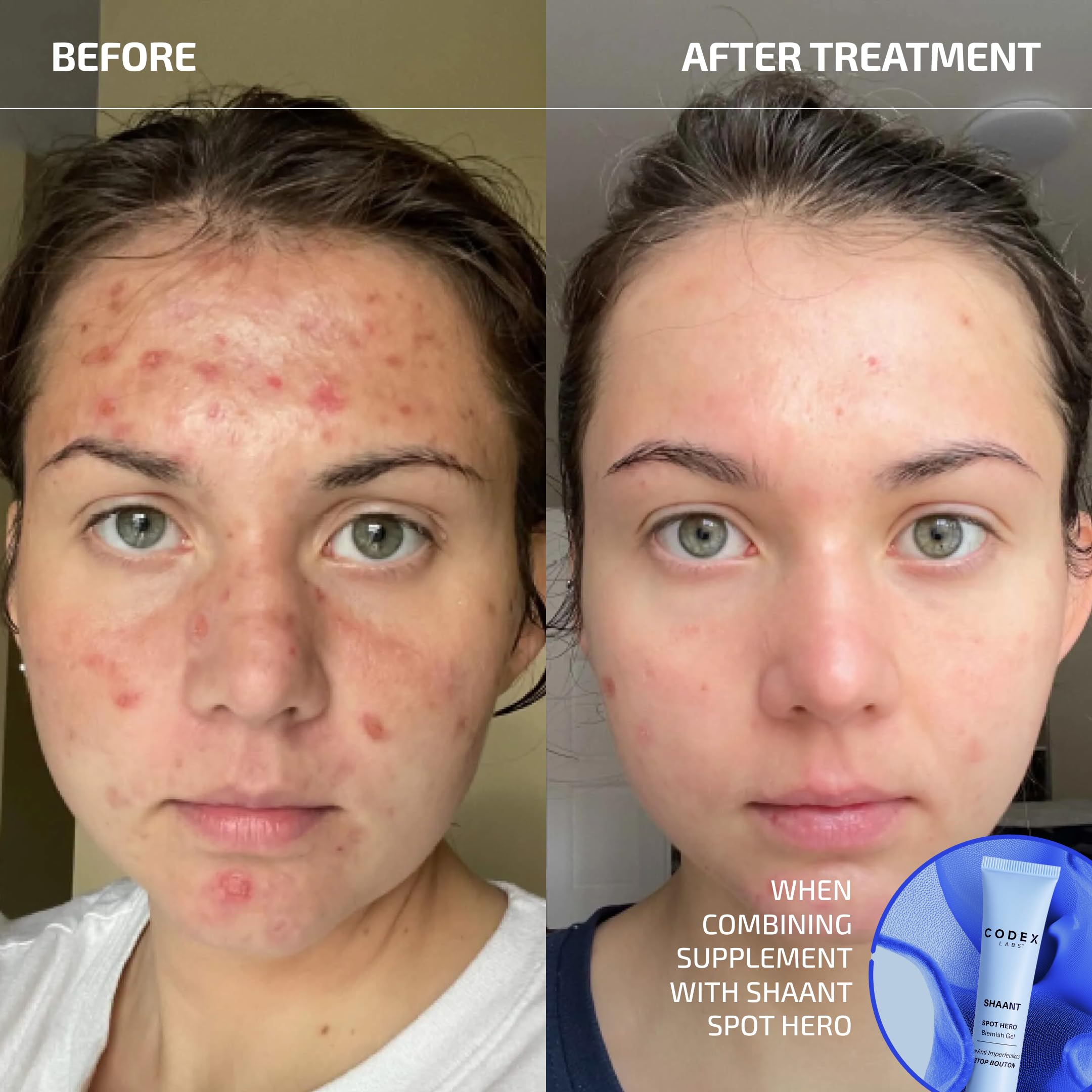 Codex Labs Shaant Clear Skin Supplement – 60 Vegan Capsules | Acne Probiotics with 9-Strain Blend, Green Tea EGCG & Guggul – Daily Support for Acne-Prone Skin & Clear Complexion Codex Labs uk supplements